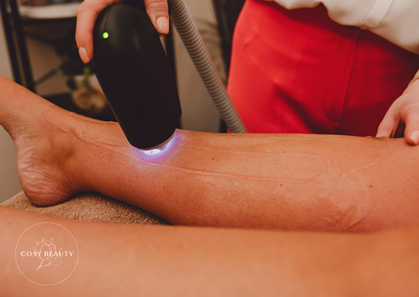 LASERONTHARING ... ALLES WAT JE MOET WETEN!